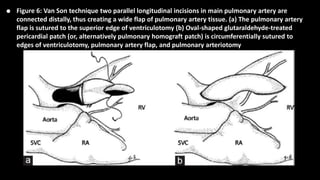 • Figure 6: Van Son technique two parallel longitudinal incisions in main pulmonary artery are
connected distally, thus creating a wide flap of pulmonary artery tissue. (a) The pulmonary artery
flap is sutured to the superior edge of ventriculotomy (b) Oval-shaped glutaraldehyde-treated
pericardial patch (or, alternatively pulmonary homograft patch) is circumferentially sutured to
edges of ventriculotomy, pulmonary artery flap, and pulmonary arteriotomy
 