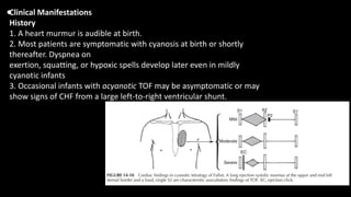 •Clinical Manifestations
History
1. A heart murmur is audible at birth.
2. Most patients are symptomatic with cyanosis at birth or shortly
thereafter. Dyspnea on
exertion, squatting, or hypoxic spells develop later even in mildly
cyanotic infants
3. Occasional infants with acyanotic TOF may be asymptomatic or may
show signs of CHF from a large left-to-right ventricular shunt.
 