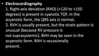 • Electrocardiography
1. Right-axis deviation (RAD) (+120 to +150
degrees) is present in cyanotic TOF. In the
acyanotic form, the QRS axis is normal.
2. RVH is usually present, but the strain pattern is
unusual (because RV pressure is
not suprasystemic). BVH may be seen in the
acyanotic form. RAH is occasionally
present.
 