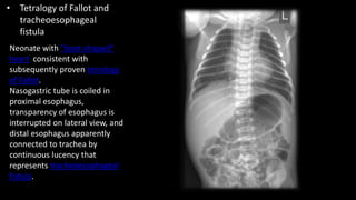 • Tetralogy of Fallot and
tracheoesophageal
fistula
Neonate with "boot-shaped"
heart consistent with
subsequently proven tetralogy
of Fallot.
Nasogastric tube is coiled in
proximal esophagus,
transparency of esophagus is
interrupted on lateral view, and
distal esophagus apparently
connected to trachea by
continuous lucency that
represents tracheoesophageal
fistula.
 