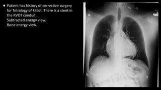 • Patient has history of corrective surgery
for Tetralogy of Fallot. There is a stent in
the RVOT conduit.
Subtracted energy view.
Bone energy view.
 
