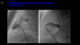 • Balloon Dilation of the Pulmonary Valve in Premature
Infants with TOF
 