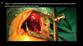 • Figure 1: A right modified Blalock–Taussig shunt through right thoracotomy with shunt size of 4 mm after
previous central shunt through median sternotomy.
 