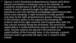 • Figures 1 and 2 Standard cardiopulmonary bypass with direct
bicaval cannulation is achieved, even in the neonate, at
a systemic temperature of 28°C to 32°C (cannulas removed for
clarity). A vent is placed through the right superior
pulmonary vein and cold blood cardioplegia administered after
aortic cross clamping. A right atriotomy is made parallel
and close to the right atrioventricular groove. Placing the incision
in this location assists in the exposure by elevating the
anterior wall of the right ventricle and tricuspid valve with the
stay sutures inserted along the atriotomy. The ventricular
septal defect is visible behind the anterior leaflet of the tricuspid
valve. Traction sutures are placed in the anterior and
septal leaflets of the tricuspid valve. In the neonate, a patent
foramen ovale is generally left open, but is closed in older
infants
 