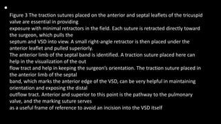 •
Figure 3 The traction sutures placed on the anterior and septal leaflets of the tricuspid
valve are essential in providing
exposure with minimal retractors in the field. Each suture is retracted directly toward
the surgeon, which pulls the
septum and VSD into view. A small right-angle retractor is then placed under the
anterior leaflet and pulled superiorly.
The anterior limb of the septal band is identified. A traction suture placed here can
help in the visualization of the out
flow tract and help in keeping the surgeon’s orientation. The traction suture placed in
the anterior limb of the septal
band, which marks the anterior edge of the VSD, can be very helpful in maintaining
orientation and exposing the distal
outflow tract. Anterior and superior to this point is the pathway to the pulmonary
valve, and the marking suture serves
as a useful frame of reference to avoid an incision into the VSD itself
 
