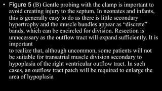 • Figure 5 (B) Gentle probing with the clamp is important to
avoid creating injury to the septum. In neonates and infants,
this is generally easy to do as there is little secondary
hypertrophy and the muscle bundles appear as “discrete”
bands, which can be encircled for division. Resection is
unnecessary as the outflow tract will expand sufficiently. It is
important
to realize that, although uncommon, some patients will not
be suitable for transatrial muscle division secondary to
hypoplasia of the right ventricular outflow tract. In such
cases, an outflow tract patch will be required to enlarge the
area of hypoplasia
 