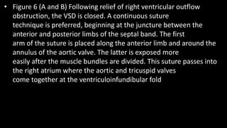 • Figure 6 (A and B) Following relief of right ventricular outflow
obstruction, the VSD is closed. A continuous suture
technique is preferred, beginning at the juncture between the
anterior and posterior limbs of the septal band. The first
arm of the suture is placed along the anterior limb and around the
annulus of the aortic valve. The latter is exposed more
easily after the muscle bundles are divided. This suture passes into
the right atrium where the aortic and tricuspid valves
come together at the ventriculoinfundibular fold
 