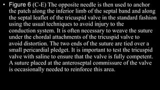 • Figure 6 (C-E) The opposite needle is then used to anchor
the patch along the inferior limb of the septal band and along
the septal leaflet of the tricuspid valve in the standard fashion
using the usual techniques to avoid injury to the
conduction system. It is often necessary to weave the suture
under the chordal attachments of the tricuspid valve to
avoid distortion. The two ends of the suture are tied over a
small pericardial pledget. It is important to test the tricuspid
valve with saline to ensure that the valve is fully competent.
A suture placed at the anteroseptal commissure of the valve
is occasionally needed to reinforce this area.
 