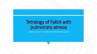 Tetralogy of Fallot with
pulmonary atresia
CHEST X-RAY ANTERIOR POSTERIOR VIEW
 