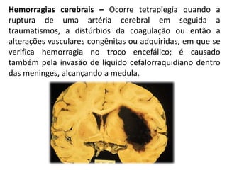 Hemorragias cerebrais – Ocorre tetraplegia quando a
ruptura de uma artéria cerebral em seguida a
traumatismos, a distúrbios da coagulação ou então a
alterações vasculares congênitas ou adquiridas, em que se
verifica hemorragia no troco encefálico; é causado
também pela invasão de líquido cefalorraquidiano dentro
das meninges, alcançando a medula.
 