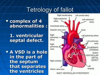 Tetrology of fallot
   complex of 4
    abnormalities :

    1. ventricular
    septal defect.

   A VSD is a hole
    in the part of
    the septum
    that separates
    the ventricles
 