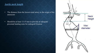 • The distance from the lowest renal artery to the origin of the
aneurysm
• Should be at least 13-15 mm to provide an adequate
proximal landing zone for endograft fixation
Aortic neck length
 