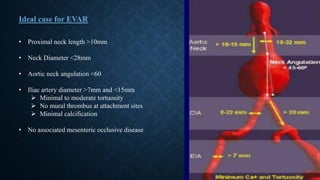• Proximal neck length >10mm
• Neck Diameter <28mm
• Aortic neck angulation <60
• Iliac artery diameter >7mm and <15mm
 Minimal to moderate tortuosity
 No mural thrombus at attachment sites
 Minimal calcification
• No associated mesenteric occlusive disease
Ideal case for EVAR
 