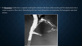 • B) Branched- Grafts have a separate small grafts sutured to the basic endovascular graft for deployment into a
vessel to preserve flow into it. Branched grafts have been designed to accommodate the hypogastric and renal
arteries.
 