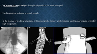 C) Chimney grafts technique- Stent placed parallel to the aortic stent graft
• Used to preserve perfusion to branch vessels
• In the absence of available fenestrated or branched grafts, chimney grafts remain a feasible endovascular option for
high risk patients.
 