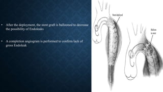 • After the deployment, the stent graft is ballooned to decrease
the possibility of Endoleaks
• A completion angiogram is performed to confirm lack of
gross Endoleak
 