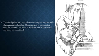 • The distal pulses are checked to assure they correspond with
the preoperative baseline. This maneuver is important as
embolic events to the lower extremities need to be realized
and acted on immediately
 