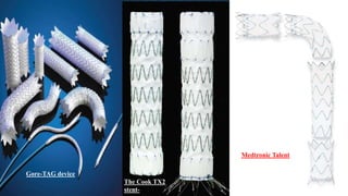 Gore-TAG device
The Cook TX2
stent-
Medtronic Talent
 