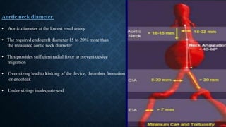 Aortic neck diameter
• Aortic diameter at the lowest renal artery
• The required endograft diameter 15 to 20% more than
the measured aortic neck diameter
• This provides sufficient radial force to prevent device
migration
• Over-sizing lead to kinking of the device, thrombus formation
or endoleak
• Under sizing- inadequate seal
 