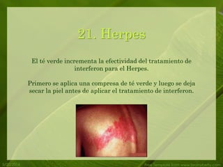 5/20/2014 Free Template from www.brainybetty.com
21. Herpes
El té verde incrementa la efectividad del tratamiento de
interferon para el Herpes.
Primero se aplica una compresa de té verde y luego se deja
secar la piel antes de aplicar el tratamiento de interferon.
 