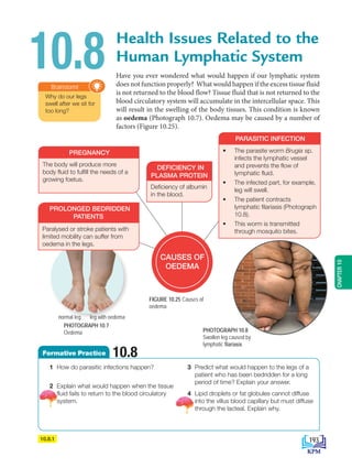 Have you ever wondered what would happen if our lymphatic system
does not function properly? What would happen if the excess tissue fluid
is not returned to the blood flow? Tissue fluid that is not returned to the
blood circulatory system will accumulate in the intercellular space. This
will result in the swelling of the body tissues. This condition is known
as oedema (Photograph 10.7). Oedema may be caused by a number of
factors (Figure 10.25).
Health Issues Related to the
Human Lymphatic System
10.8
Why do our legs
swell after we sit for
too long?
Brainstorm!
PHOTOGRAPH 10.8
Swollen leg caused by
lymphatic filariasis
FIGURE 10.25 Causes of
oedema
10.8.1
PARASITIC INFECTION
• The parasite worm Brugia sp.
infects the lymphatic vessel
and prevents the flow of
lymphatic fluid.
• The infected part, for example,
leg will swell.
• The patient contracts
lymphatic filariasis (Photograph
10.8).
• This worm is transmitted
through mosquito bites.
DEFICIENCY IN
PLASMA PROTEIN
Deficiency of albumin
in the blood.
CAUSES OF
OEDEMA
1 How do parasitic infections happen?
2 Explain what would happen when the tissue
fluid fails to return to the blood circulatory
system.
3 Predict what would happen to the legs of a
patient who has been bedridden for a long
period of time? Explain your answer.
4 Lipid droplets or fat globules cannot diffuse
into the villus blood capillary but must diffuse
through the lacteal. Explain why.
Formative Practice 10.8
leg with oedema
normal leg
PREGNANCY
The body will produce more
body fluid to fulfill the needs of a
growing foetus.
PROLONGED BEDRIDDEN
PATIENTS
Paralysed or stroke patients with
limited mobility can suffer from
oedema in the legs.
PHOTOGRAPH 10.7
Oedema
193
CHAPTER
10
BioT4(NC)-B10B-EN New 6th.indd 193 1/9/2020 12:09:40 PM
 