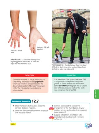 12.7.1
PHOTOGRAPH 12.6 The hands of a 12-year-old
boy with gigantism. Observe that his hands are
bigger than that of a normal adult
PHOTOGRAPH 12.7 Chandra Bahadur Dangi from Nepal
(0.55 m), the shortest man in the world and Sultan Kosen
(2.47 m), the tallest man in the world
hands of a child with
gigantism
hands of a normal
adult
Low secretion of the growth hormone (GH)
during the period of growth delays the
growth of bones and causes a condition
called dwarfism (Photograph 12.7). Organs
also fail to develop and parts of the body
ratio remain as that of a child.
DWARFISM
1 State the factors that cause a person to
contract diabetes insipidus.
2 State two symptoms experienced by people
with diabetes mellitus.
3 Goitre is a disease that causes the
enlargement of the thyroid gland. In your
opinion, why are goitre patients encouraged
to eat seafood?
4 Suggest a treatment for children with
stunted growth due to growth hormone
deficiency.
12.7
Formative Practice
Excessive secretion of the growth hormone
(GH) during childhood causes gigantism
which is a condition characterised by the
abnormal elongation of bones (Photograph
12.6). The individual grows to become
extremely tall.
GIGANTISM
239
CHAPTER
12
BioT4(6th)-B12-FA-EN New 6th.indd 239 1/9/2020 11:58:27 AM
 