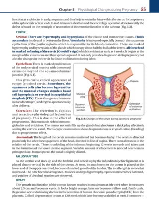 Chapter 5 Physiological Changes during Pregnancy 55
functionasasphincterinearlypregnancyandthushelptoretainthefetuswithintheuterus.Incompetency
of the sphincteric action leads to mid-trimester abortion and the encirclage operation done to rectify the
defect is based on the principle of restoration of the retentive function of the isthmus (Fig. 5.3).
CERVIX
Stroma: There are hypertrophy and hyperplasia of the elastic and connective tissues. Fluids
accumulate inside and in between the fibers.Vascularity is increased especially beneath the squamous
epithelium of the portio vaginalis which is responsible for its bluish coloration. There are marked
hypertrophy and hyperplasia of the glands which occupy about half the bulk of the cervix. All these lead
to marked softening of the cervix (Goodell’s sign) which is evident as early as 6 weeks. It begins at the
margin of the external os and then spreads upward. It not only provides diagnostic aid in pregnancy but
also the changes in the cervix facilitate its dilatation during labor.
Epithelium: There is marked proliferation
of the endocervical mucosa with downward
extension beyond the squamocolumnar
junction (Fig. 5.4).
This gives rise to clinical appearance of
ectopy (erosion) cervix. Sometimes, the
squamous cells also become hyperactive
and the mucosal changes simulate basal
cell hyperplasia or cervical intraepithelial
neoplasia(CIN).These changes are hormone
induced (estrogen) and regress spontaneously
after delivery.
Secretion: The secretion is copious
and tenacious-physiological leukorrhea
of pregnancy. This is due to the effect of
progesterone. This mucous is rich in immuno-
globulins and cytokines. The mucus not only fills up the glands but also forms a thick plug effectively
sealing the cervical canal. Microscopic examination shows fragmentation or crystallization (beading)
due to progesterone effect.
Anatomical: The length of the cervix remains unaltered but becomes bulky. The cervix is directed
posteriorly but after the engagement of the head, directed in line of vagina. There is no alteration in the
relation of the cervix. There is unfolding of the isthmus; beginning 12 weeks onwards and takes part
in the formation of the lower uterine segment. Variable amount of effacement is noticed near term in
primigravidae. In multiparae, the canal is slightly dilated.
FALLOPIAN TUBE
As the uterine end rises up and the fimbrial end is held up by the infundibulopelvic ligament, it is
placed almost vertical by the side of the uterus. At term, its attachment to the uterus is placed at the
lower end of the upper one-third, because of marked growth of the fundus. The total length is somewhat
increased. The tube becomes congested. Muscles undergo hypertrophy. Epithelium becomes flattened,
and patches of decidual reaction are observed.
OVARY
The growth and function of the corpus luteum reaches its maximum at 8th week when it measures
about 2.5 cm and becomes cystic. It looks bright orange, later on becomes yellow and, finally pale.
Regression occurs following decline in the secretion of human chorionic gonadotropin (hCG) from the
placenta. Colloid degeneration occurs at 12th week which later becomes calcified at term. Hormones—
Fig. 5.4: Changes of the cervix during advanced pregnancy
Ch-05.indd 55 2/4/2015 10:54:25 AM
 