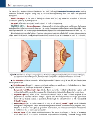 74 Textbook of Obstetrics
the uterus, (2) congestion of the bladder mucosa and (3) change in maternal osmoregulation causing
increased thirst and polyuria (see p. 58). As the uterus straightens up after 12th week, the symptom
disappears.
Breast discomfort in the form of feeling of fullness and ‘pricking sensation’ is evident as early as
6–8th week specially in primigravidae.
Fatigue is a frequent symptom which may occur early in pregnancy.
OBJECTIVE SIGNS:  Breast changes are valuable only in primigravidae, as in multiparae, the breasts
areenlargedandoftencontainmilkforyears.Thebreastchangesareevidentbetween6and8weeks.There
isenlargementwithvascularengorgementevidencedbythedelicateveinsvisibleundertheskin(Fig.7.1).
Thenippleandtheareola(primary)becomemorepigmentedspeciallyindarkwomen.Montgomery’s
tubercles are prominent. Thick yellowish secretion (colostrum) can be expressed as early as 12th week.
Figs 7.1A and B: Breast changes during pregnancy; (A) Pronounced pigmentation of the primary areola and nipple;
(B) Appearance of secondary areola, development of Montgomery tubercles and increased vascularity
A B
 Per abdomen — Uterus remains a pelvic organ until 12th week, it may be just felt per abdomen as
a suprapubic bulge.
 Pelvicchanges— The pelvic changes are diverse and appear at different periods. Collectively, these
may be informative in arriving at a diagnosis of pregnancy.
 Jacquemier’s or Chadwick’s sign: It is the dusky hue of the vestibule and anterior vaginal wall
visible at about 8th week of pregnancy. The discoloration is due to local vascular congestion.
 Vaginal sign: (a) Apart from the bluish discoloration of the anterior vaginal wall
(b) The walls become softened and (c) Copious non-irritating mucoid discharge appears at
6th week (d) There is increased pulsation, felt through the lateral fornices at 8th week called
Osiander’s sign.
 Cervical signs: (a) Cervix becomes soft as early as 6th week (Goodell’s sign), a little earlier in
multiparae. The pregnant cervix feels like the lips of the mouth, while in the non-pregnant state,
like that of tip of the nose. (b) On speculum examination, the bluish discoloration of the cervix
is visible. It is due to increased vascularity.
 Uterine signs: (a) Size, shape and consistency — The uterus is enlarged to the size of hen’s egg
at 6th week, size of a cricket ball at 8th week and size of a fetal head by 12th week. The pyriform
Ch-07.indd 74 2/4/2015 10:57:58 AM
 