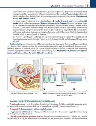 Chapter 7 Diagnosis of Pregnancy 75
shape of the non-pregnant uterus becomes globular by 12 weeks. There may be asymmetrical
enlargement of the uterus if there is lateral implantation. This is called Piskacek’s sign where one
half is more firm than the other half. As pregnancy advances, symmetry is restored. The pregnant
uterus feels soft and elastic.
(b) Hegar’s sign: It is present in two-thirds of cases. It can be demonstrated between 6 and 10
weeks, a little earlier in multiparae. This sign is based on the fact that: (1) upper part of the body
of the uterus is enlarged by the growing fetus (2) lower part of the body is empty and extremely
soft and (3) the cervix is comparatively firm. Because of variation in consistency, on bimanual
examination (two fingers in the anterior fornix and the abdominal fingers behind the uterus), the
abdominalandvaginalfingersseemtoapposebelowthebodyoftheuterus(Fig.7.2).Examination
must be gentle to avoid the risk of abortion.
(c) Palmer’s sign: Regular and rhythmic uterine contraction can be elicited during bimanual
examination as early as 4–8 weeks. Palmer in 1949, first described it and it is a valuable sign when
elicited.
To elicit the test, the uterus is cupped between the internal fingers and the external fingers for about
2–3 minutes. During contraction, the uterus becomes firm and well defined but during relaxation,
becomes soft and ill defined. While the contraction phase lasts for about 30 seconds, with increasing
duration of pregnancy, the relaxation phase increases (Fig. 7.3). After 10th week, the relaxation phase
is so much increased that the test is difficult to perform.
Fig. 7.2: Demonstration of Hegar’s sign
A B
Fig. 7.3: Graphic representation of Palmer’s sign — (A) at 4–8th
week, (B) at 10th week
IMMUNOLOGICAL TESTS FOR DIAGNOSIS OF PREGNANCY
Principle: Pregnancy tests depend on detection of the antigen (hCG) present in the maternal urine
or serum with antibody either polyclonal or monoclonal available commercially (Table 7.1).
Tests used: A. Immunoassays without radioisotopes
 Agglutinationinhibitiontests— Using latex (LAI). The materials for these tests are supplied in kits containing
all the reagents needed to do a test.
Principle of agglutination inhibition tests: One drop of urine is mixed with one drop of a solution that contains
hCG antibody. If hCG is not present in the urine sample (e.g. the woman is not pregnant), the antibody remains
Ch-07.indd 75 2/4/2015 10:57:59 AM
 