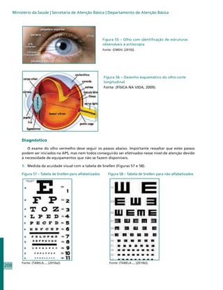 Ministério da Saúde | Secretaria de Atenção Básica | Departamento de Atenção Básica




                                                              Figura 55 – Olho com identificação de estruturas
                                                              observáveis à ectoscopia
                                                              Fonte: (CMDV, [2010]).




                                                              Figura 56 – Desenho esquemático do olho-corte
                                                              longitudinal
                                                              Fonte: (FÍSICA NA VIDA, 2009).




           Diagnóstico

              O exame do olho vermelho deve seguir os passos abaixo. Importante ressaltar que estes passos
           podem ser iniciados na APS, mas nem todos conseguirão ser efetivados nesse nível de atenção devido
           à necessidade de equipamentos que não se fazem disponíveis.

           1.	 Medida da acuidade visual com a tabela de Snellen (Figuras 57 e 58).

           Figura 57 – Tabela de Snellen para alfabetizados      Figura 58 – Tabela de Snellen para não alfabetizados




              	




           Fonte: (TABELA..., [2010a]).			                        Fonte: (TABELA..., [2010b]).
208
 