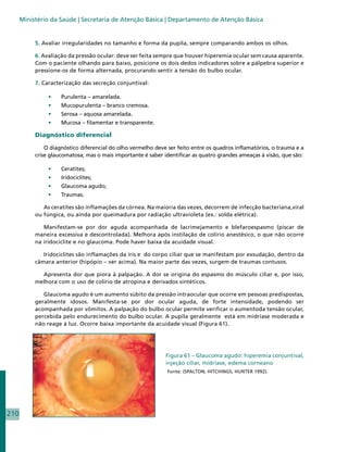Ministério da Saúde | Secretaria de Atenção Básica | Departamento de Atenção Básica


           5. Avaliar irregularidades no tamanho e forma da pupila, sempre comparando ambos os olhos.

           6. Avaliação da pressão ocular: deve ser feita sempre que houver hiperemia ocular sem causa aparente.
           Com o paciente olhando para baixo, posicione os dois dedos indicadores sobre a pálpebra superior e
           pressione-os de forma alternada, procurando sentir a tensão do bulbo ocular.

           7. Caracterização das secreção conjuntival:

                •	   Purulenta – amarelada.
                •	   Mucopurulenta – branco cremosa.
                •	   Serosa – aquosa amarelada.
                •	   Mucosa – filamentar e transparente.

           Diagnóstico diferencial

               O diagnóstico diferencial do olho vermelho deve ser feito entre os quadros inflamatórios, o trauma e a
           crise glaucomatosa, mas o mais importante é saber identificar as quatro grandes ameaças à visão, que são:

                •	   Ceratites;
                •	   Iridociclites;
                •	   Glaucoma agudo;
                •	   Traumas.

              As ceratites são inflamações da córnea. Na maioria das vezes, decorrem de infecção bacteriana,viral
           ou fúngica, ou ainda por queimadura por radiação ultravioleta (ex.: solda elétrica).

              Manifestam-se por dor aguda acompanhada de lacrimejamento e blefaroespasmo (piscar de
           maneira excessiva e descontrolada). Melhora após instilação de colírio anestésico, o que não ocorre
           na iridociclite e no glaucoma. Pode haver baixa da acuidade visual.

              Iridociclites são inflamações da íris e do corpo ciliar que se manifestam por exsudação, dentro da
           câmara anterior (hipópio – ver acima). Na maior parte das vezes, surgem de traumas contusos.

             Apresenta dor que piora à palpação. A dor se origina do espasmo do músculo ciliar e, por isso,
           melhora com o uso de colírio de atropina e derivados sintéticos.

              Glaucoma agudo é um aumento súbito da pressão intraocular que ocorre em pessoas predispostas,
           geralmente idosos. Manifesta-se por dor ocular aguda, de forte intensidade, podendo ser
           acompanhada por vômitos. A palpação do bulbo ocular permite verificar o aumentoda tensão ocular,
           percebida pelo endurecimento do bulbo ocular. A pupila geralmente está em midríase moderada e
           não reage à luz. Ocorre baixa importante da acuidade visual (Figura 61).




                                                              Figura 61 – Glaucoma agudo: hiperemia conjuntival,
                                                              injeção ciliar, midríase, edema corneano
                                                               Fonte: (SPALTON; HITCHINGS; HUNTER 1992).




210
 