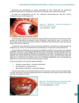 ACOLHIMENTO À DEMANDA ESPONTÂNEA – Queixas mais comuns na Atenção Básica


   Episclerites são vermelhidões em pontos localizados do olho. Diferenciam da conjuntivite
exatamente pelo fato de a hiperemia conjuntival ser localizada e pela ausência de secreção.

   Às vezes são acompanhadas de dor que melhoram espontaneamente. Não têm maiores
consequências para o olho (Figura 62).




                                                  Figura 62 – Episclerite – hipermia localizada na
                                                  conjuntiva bulbar temporal
                                                  Fonte: (EPISCLERITE..., [2010]).




   As hemorragias conjuntivais são coleções de sangue debaixo da conjuntiva. Na maioria das vezes,
resultam do sangramento de pequenos vasos conjuntivais, após esforços como o de evacuar ou
decorrentes de pico hipertensivo arterial sistêmico. Melhoram espontaneamente, pela absorção do
sangue pelo próprio organismo.

   As blefarites são inflamações crônicas das bordas palpebrais, resultantes da superpopulação de
Staphylococcus. O olho fica constantemente avermelhado por irritação das toxinas bacterianas.

   Conjuntivites são inflamações da conjuntiva, que podem ter bactéria, vírus ou fungo como agentes
etiológicos, além de ter causa alérgica. Manifestam-se clinicamente por: sensação de corpo estranho,
hiperemia conjuntival, edema palpebral (mais acentuado e persistente nas conjuntivites virais com
formação de pseudomembrana), fotofobia, lacrimejamento, prurido e embaçamento visual, que
melhora com o piscar, porque decorre do acúmulo de secreção, exceto nas conjuntivites virais por
adenovírus e enterovírus, que podem cursar com infiltrados subepiteliais, que, se localizados na
região do eixo visual, levam à baixa visual de duração variável.

O tipo de secreção dá uma pista do agente etiológico:

    •	   Secreção mucopurulenta – conjuntivite bacteriana.
    •	   Secreção serosa – conjuntivite viral.
    •	   Muco hialino e filamentos – conjuntivite alérgica.

   O tempo de evolução da conjuntivite bacteriana é em torno de 3 a 5 dias, já nas virais pode chegar
a 15 dias, sendo que a conjuntiva poderá permanecer vermelha por mais tempo se houver hemorragia
subconjuntival (Figuras 63 a 66).




                                                  Figura 63 – Pseudomembrana em conjuntiva tarsal,
                                                  observável após eversão da pálpebra superior
                                                  Fonte: (PSEUDOMENBRANA..., [2010]).




                                                                                                        211
 