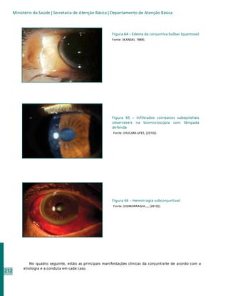 Ministério da Saúde | Secretaria de Atenção Básica | Departamento de Atenção Básica




                                                           Figura 64 – Edema da conjuntiva bulbar (quemose)
                                                           Fonte: (KANSKI, 1989).




                                                           Figura 65 – Infiltrados corneanos subepiteliais
                                                           observáveis na biomicroscopia com lâmpada
                                                           defenda
                                                            Fonte: (HUCAM-UFES, [2010]).




                                                           Figura 66 – Hemorragia subconjuntival
                                                            Fonte: (HEMORRAGIA..., [2010]).




              No quadro seguinte, estão as principais manifestações clínicas da conjuntivite de acordo com a
           etiologia e a conduta em cada caso.
212
 