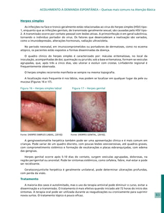 ACOLHIMENTO À DEMANDA ESPONTÂNEA – Queixas mais comuns na Atenção Básica


Herpes simples

    As infecções na face e tronco geralmente estão relacionadas ao vírus do herpes simples (HSV) tipo-
1, enquanto que as infecções genitais, de transmissão geralmente sexual, são causadas pelo HSV tipo-
2. A transmissão ocorre por contato pessoal com lesões ativas. A primoinfecção é em geral subclínica,
tornando o indivíduo portador do vírus. Os fatores que desencadeiam a reativação são variados,
como a imunodepressão, alterações hormonais, radiação ultravioleta.

   No período neonatal, em imunocomprometidos ou portadores de dermatoses, como no eczema
atópico, os pacientes estão expostos a formas disseminadas da doença.

   O quadro clínico do herpes simples é caracterizado por: máculas eritematosas, no local da
inoculação, acompanhadas de dor, queimação ou prurido; sob a base eritematosa, formam-se vesículas
agrupadas, que, após três a cinco dias, vão ulcerar e evoluir com crostas. Linfadenite regional é
frequentemente observada.

   O herpes simples recorrente manifesta-se sempre na mesma topografia.

  A localização mais frequente é nos lábios, mas podem se localizar em qualquer lugar da pele ou
mucosa (Figuras 16 e 17).

Figura 16 – Herpes simples labial	        Figura 17 – Herpes genital




Fonte: (HERPES SIMPLES LABIAL, [2010])   Fonte: (HERPES GENITAL, [2010]).

    A gengivoestomatite herpética também pode ser uma apresentação clínica e é mais comum em
crianças. Pode variar de um quadro discreto, com poucas lesões vesicoerosivas, até quadros graves,
com comprometimento sistêmico e formação de exulcerações e placas esbranquiçadas, com edema
das gengivas.

    Herpes genital ocorre após 5-10 dias do contato, surgem vesículas agrupadas, dolorosas, na
região perigenital ou anoretal. Pode ter sintomas sistêmicos, como cefaleia, febre, mal-estar e pode
ser recidivante.

   Ceratoconjuntivite herpética é geralmente unilateral, pode determinar ulcerações profundas,
com perda da visão.

Tratamento

    A maioria dos casos é autolimitado, mas o uso da terapia antiviral pode diminuir o curso, evitar a
disseminação e a transmissão. O tratamento é mais efetivo quando iniciado até 72 horas do início dos
sintomas. A terapia oral pode ser utilizada durante as reagudizações ou cronicamente para suprimir
novos surtos. O tratamento tópico é pouco eficaz.                                                        83
 