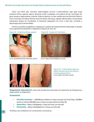 Ministério da Saúde | Secretaria de Atenção Básica | Departamento de Atenção Básica


             Evolui com febre alta, mal-estar, adenomegalia cervical e submandibular, logo após surge
          exantema difuso, papular, áspero, deixando a pele, à palpação, com aspecto de lixa, centrífugo. Em
          geral, poupa a região palmar e plantar. Pode-se observar, na face, palidez perioral (sinal de Filatov) e
          linhas marcadas nas dobras flexoras (sinal de Pastia). Na língua, papilas edemaciadas e eritematosas
          sobressaem (língua em framboesa). O exantema desaparece em cinco a sete dias, iniciando a
          descamação até as extremidades.

              Eritema e exsudato amigdaliano e petéquias no palato são frequentemente observados. O quadro
          clínico geralmente possibilita o diagnóstico (Figuras 25, 26 e 27).

          Figura 25 – Exantema difuso, papular         Figura 26 - Língua em framboesa




          Fonte: (EXANTEMA DIFUSO PAPULAR, [2010]).	   Fonte: (LINGUA EM FRAMBOESA, [2010]).




                                                                          Figura 27 – Linhas demarcadas nas
                                                                          dobras flexoras (Sinal de Pastia) e
                                                                          eritema papular difuso
                                                                          Fonte: (SINAL DE PASTIA, (2010)).




          Diagnóstico laboratorial: cultura de secreção de orofaringe com isolamento do Streptococcus
          pode auxiliar no diagnóstico.

          Tratamento

               •	   Penicilina benzatina – 1.200.000 para adultos e crianças com peso acima de 27kg; e 50.000U/
                    kg até no máximo 900.000U para crianças com peso abaixo de 27kg, IM;
               •	   Amoxicilina – 50mg a 70mg/kg/dia, a cada oito horas, por dez dias;
               •	   Eritromicina – 30mg a 50mg/kg/dia em crianças, por sete dias.

          Profilaxia com antibióticos em contactantes é controversa.
90
 