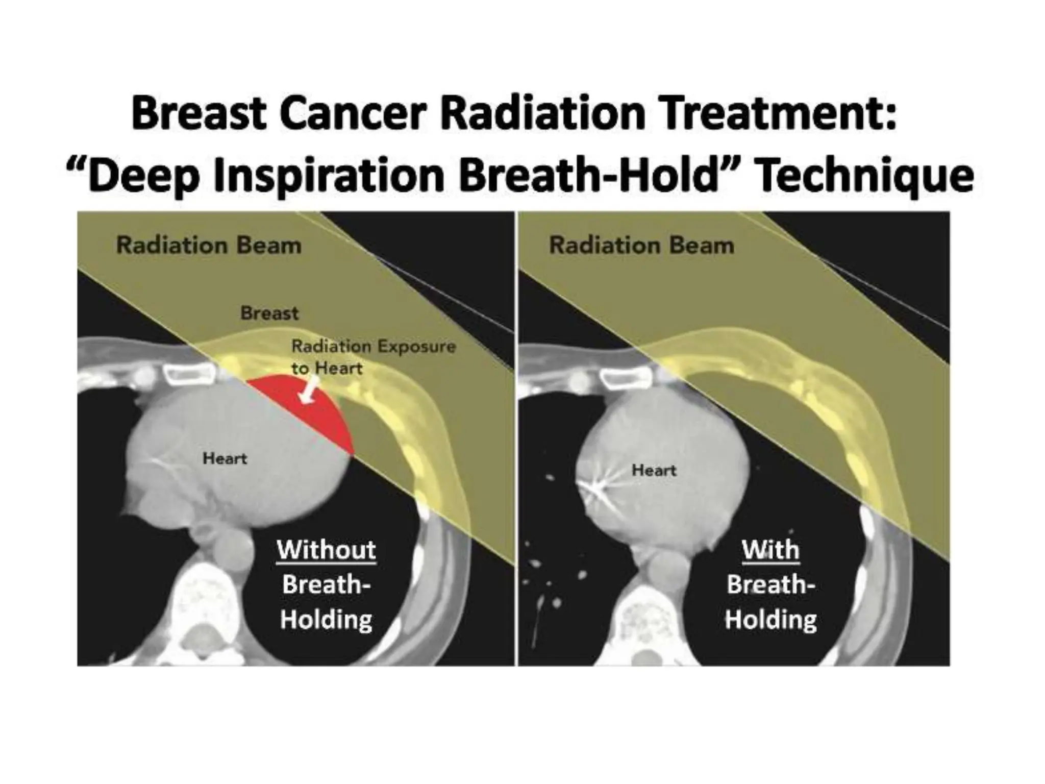 RECENT ADVANCES IN BREAST CANCER RADIOTHERAPY | PPTX