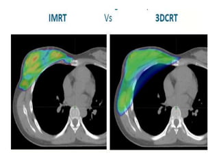 RECENT ADVANCES IN BREAST CANCER RADIOTHERAPY | PPTX