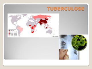 TUBERCULOSE
 