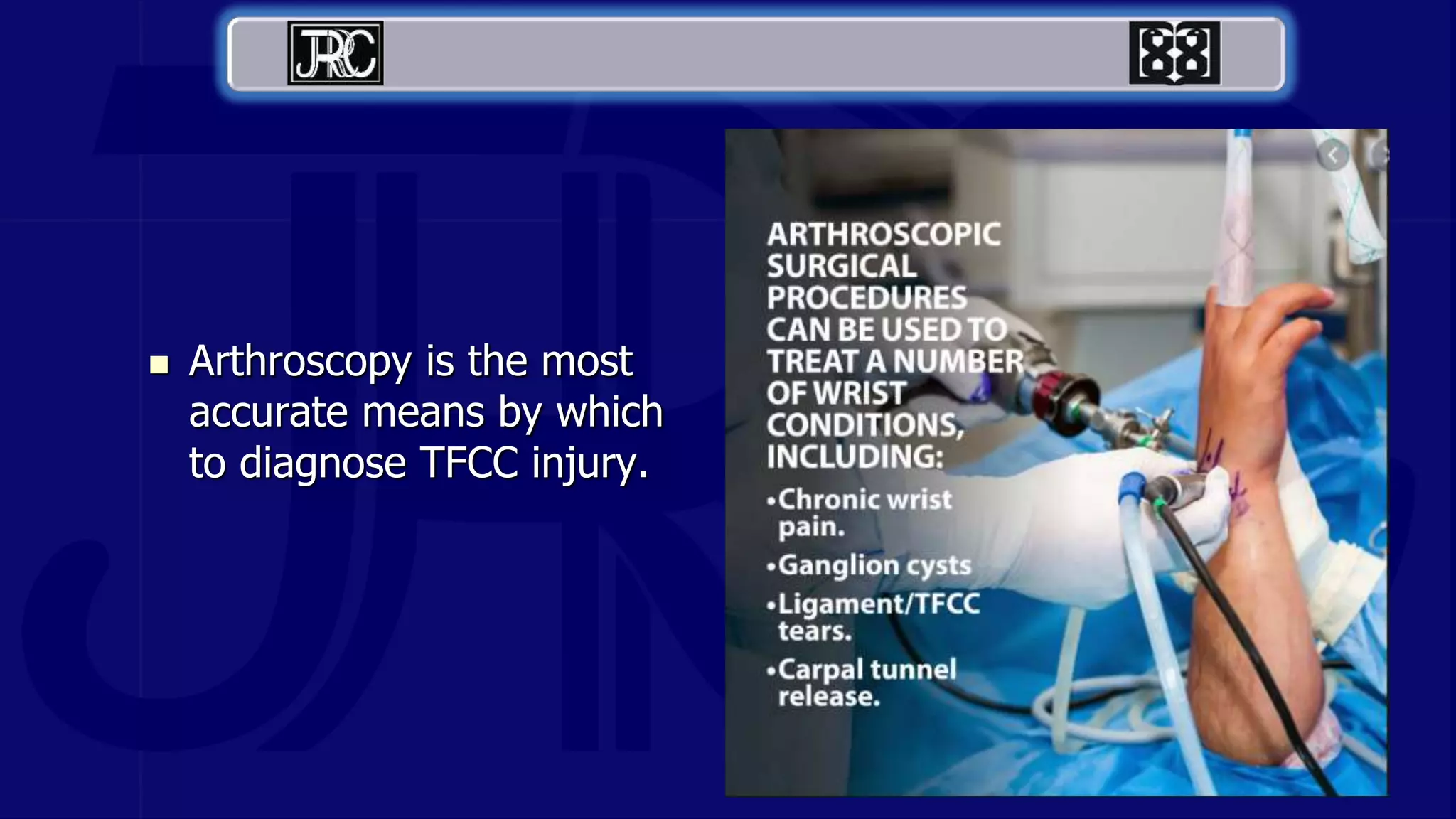  Arthroscopy is the most
accurate means by which
to diagnose TFCC injury.
 