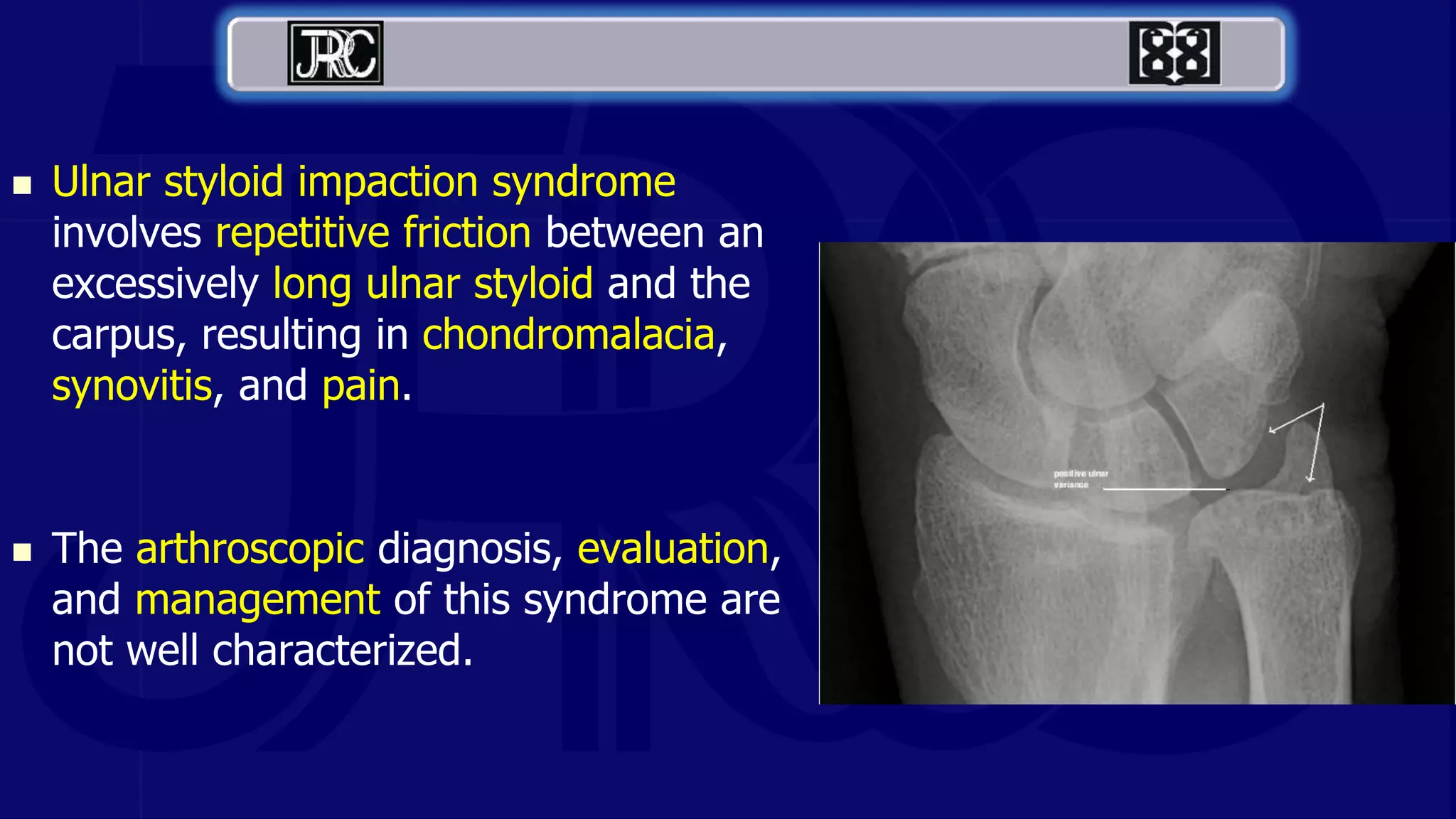  Ulnar styloid impaction syndrome
involves repetitive friction between an
excessively long ulnar styloid and the
carpus, resulting in chondromalacia,
synovitis, and pain.
 The arthroscopic diagnosis, evaluation,
and management of this syndrome are
not well characterized.
 