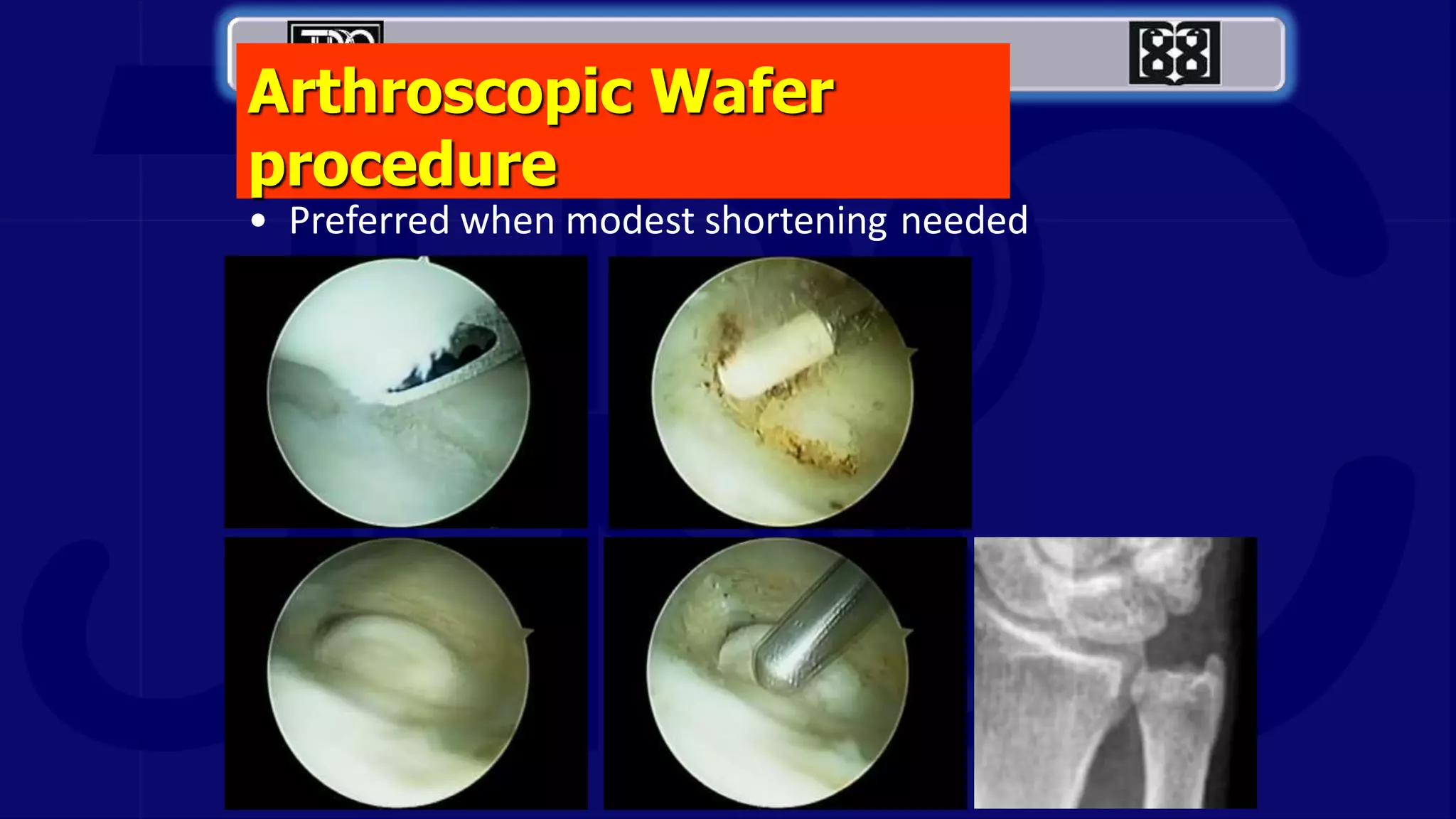 Arthroscopic Wafer
procedure
• Preferred when modest shortening needed
 