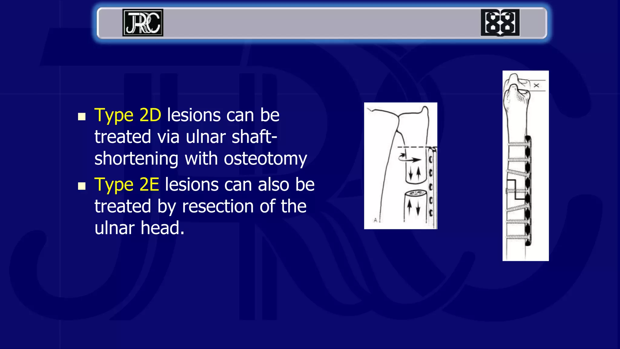 Type 2D lesions can be
treated via ulnar shaft-
shortening with osteotomy
 Type 2E lesions can also be
treated by resection of the
ulnar head.
 