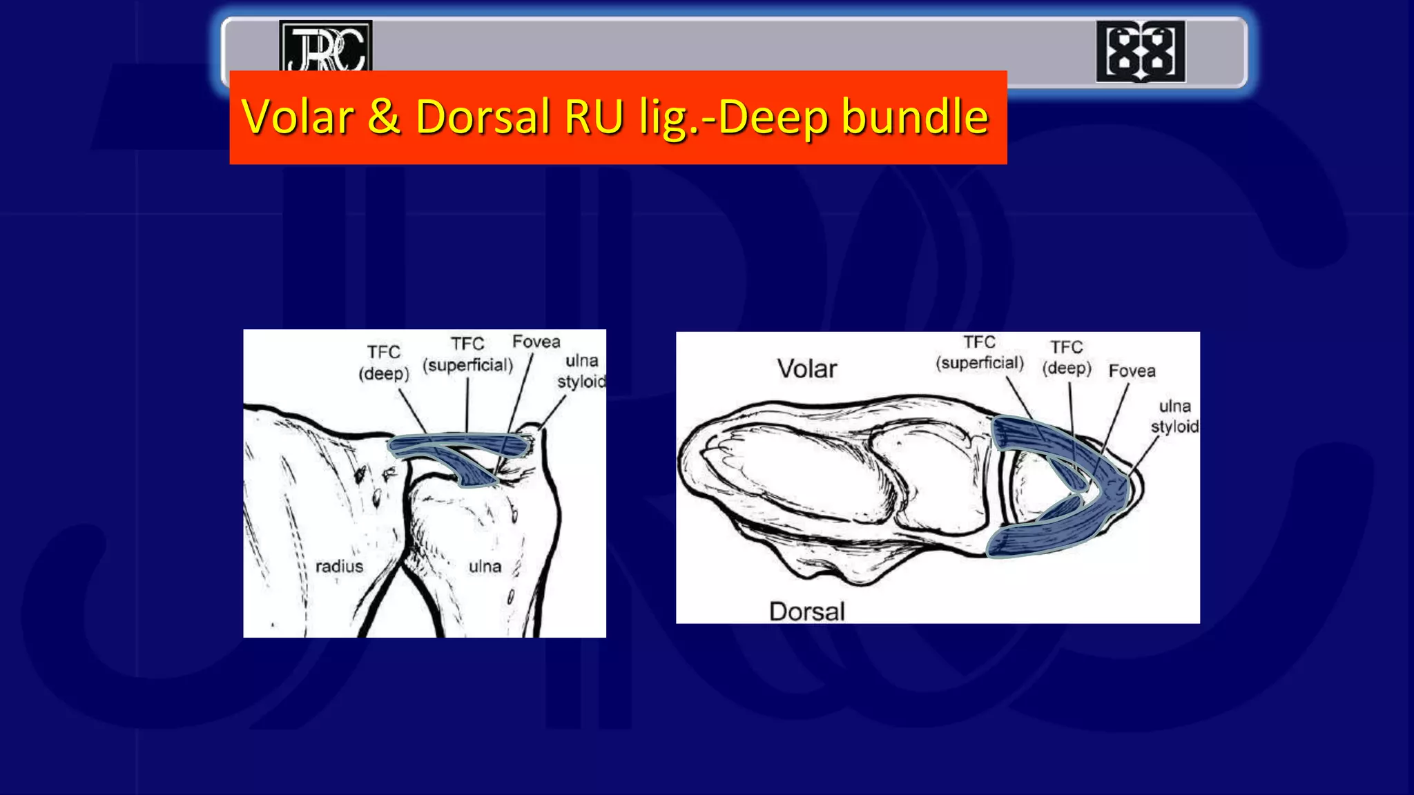Volar & Dorsal RU lig.-Deep bundle
 