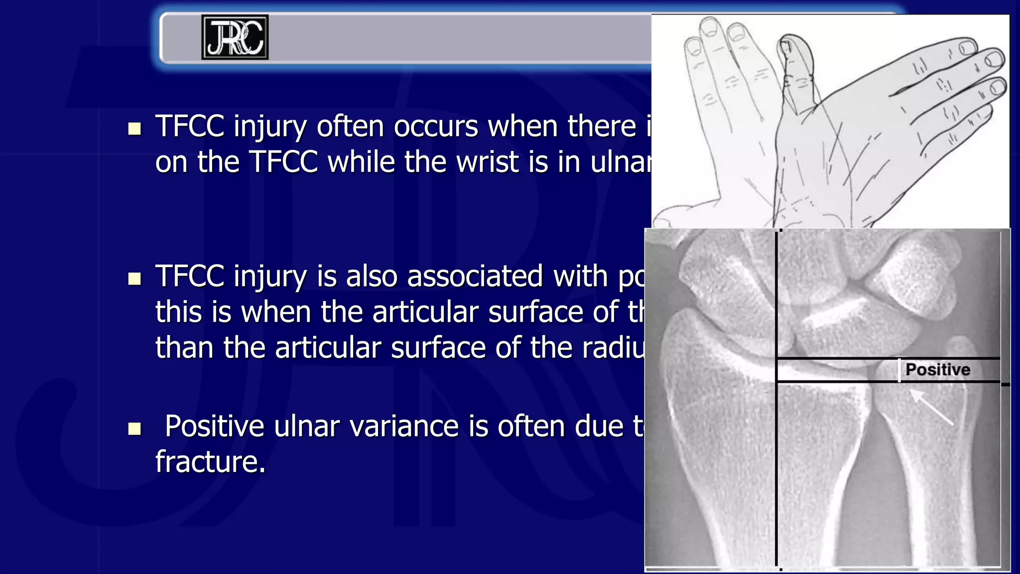  TFCC injury often occurs when there is a load compressed
on the TFCC while the wrist is in ulnar deviation.
 TFCC injury is also associated with positive ulnar variance;
this is when the articular surface of the ulna is more distal
than the articular surface of the radius.
 Positive ulnar variance is often due to prior surgery or prior
fracture.
 