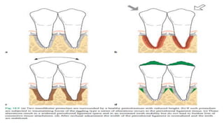 Healthy periodontium with reduced bone height
31
 
