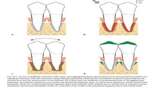 Periodontitis with reduced bone height
32
 