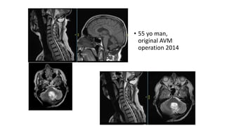 AHV6121
• 55 yo man,
original AVM
operation 2014
 
