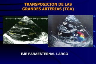 TRANSPOSICION DE LAS GRANDES ARTERIAS (TGA) EJE PARAESTERNAL LARGO 