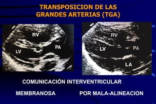 TRANSPOSICION DE LAS GRANDES ARTERIAS (TGA) COMUNICACIÓN INTERVENTRICULAR MEMBRANOSA POR MALA-ALINEACION 