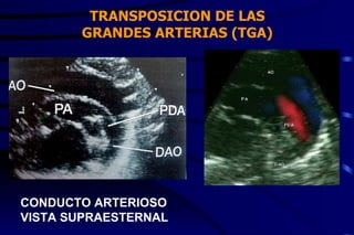 TRANSPOSICION DE LAS GRANDES ARTERIAS (TGA) CONDUCTO ARTERIOSO VISTA SUPRAESTERNAL 